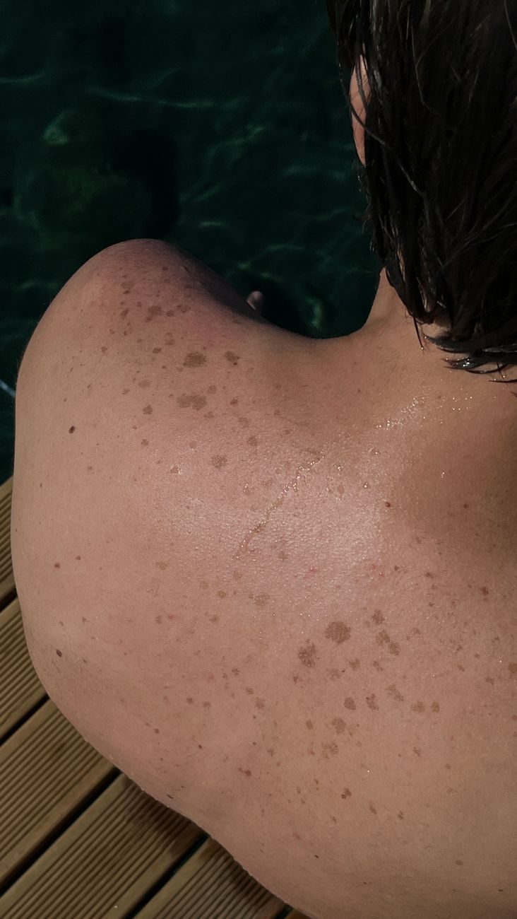Sun-exposed shoulder skin covered in freckles and sun spots, the visible record of cumulative ultraviolet damage
